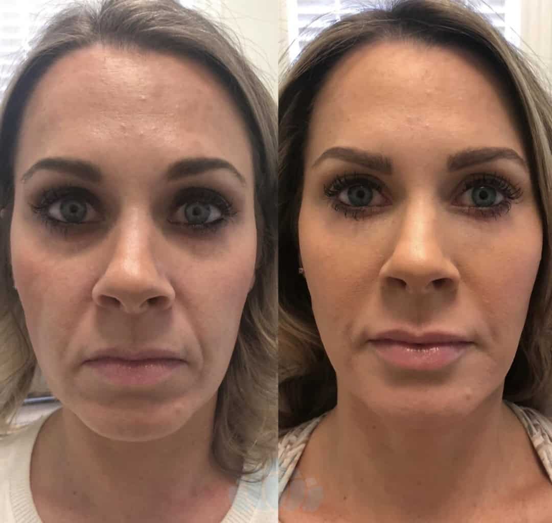 Facelift