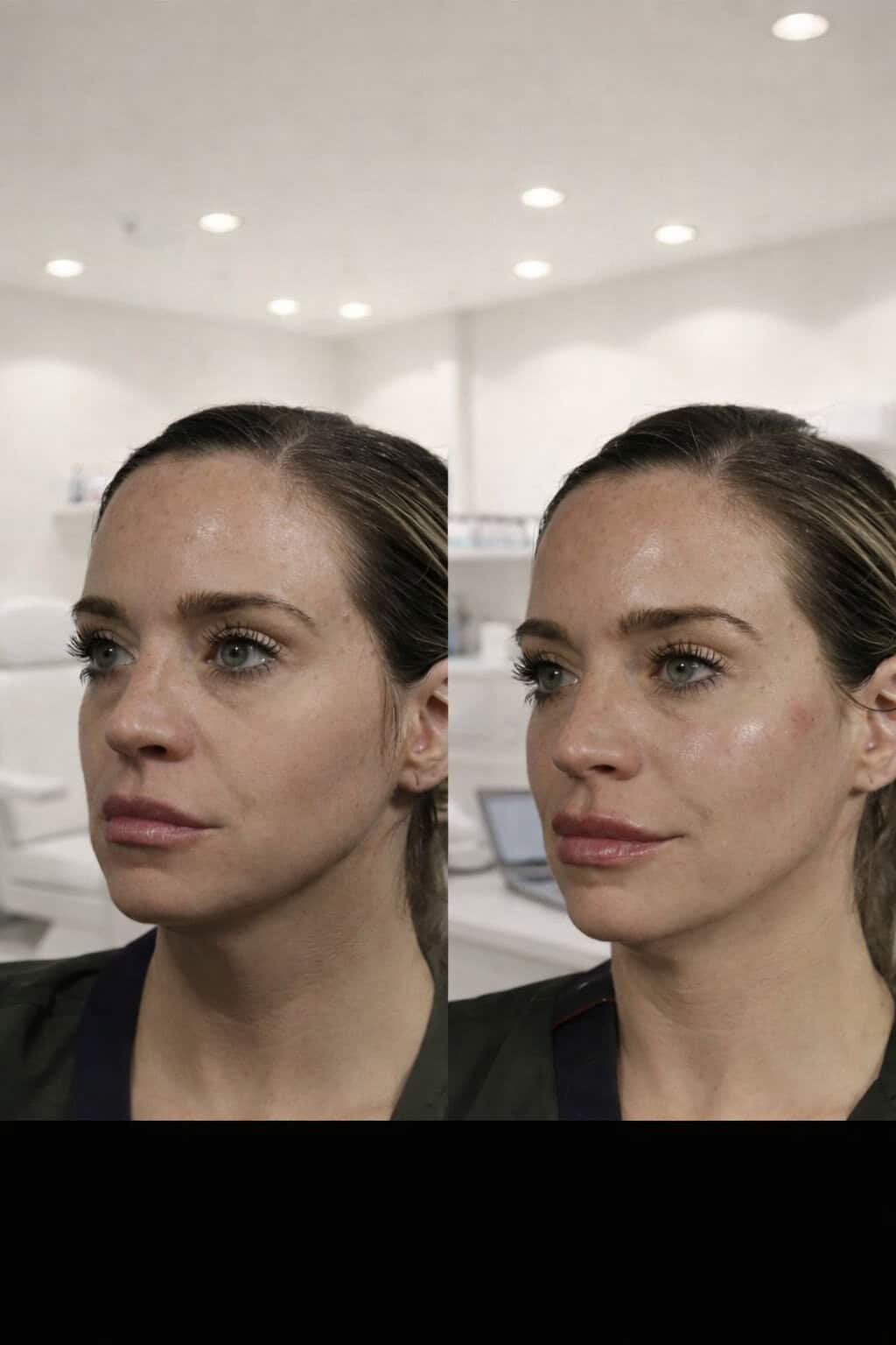 Cheek Filler